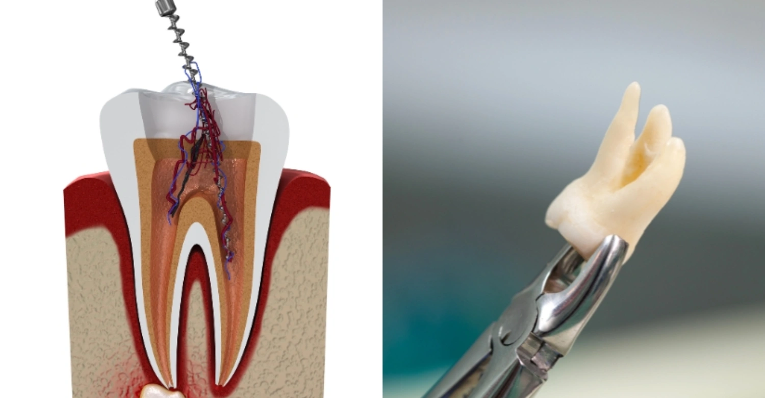 Root Canal or Tooth Extraction Which Dental Treatment Is Better In blog